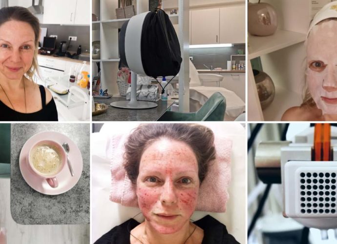 Davida mikrotűs arckezelésen vett részt az EverDermnél.