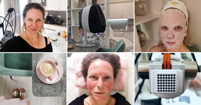 Davida mikrotűs arckezelésen vett részt az EverDermnél.