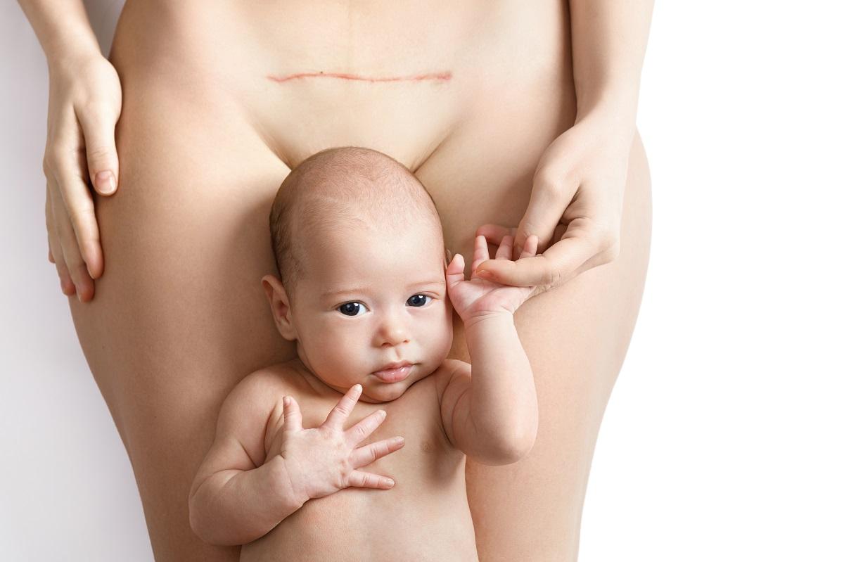 Császárvonal-császármetszés-segítség